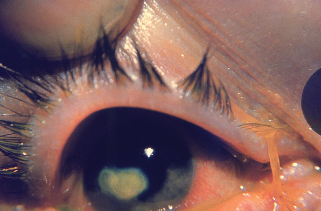 White spot on eye: Causes, symptoms, and treatment