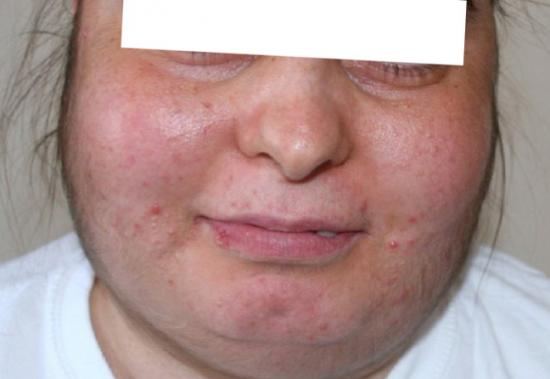 Face swelling: Causes, treatment, and when to see a doctor