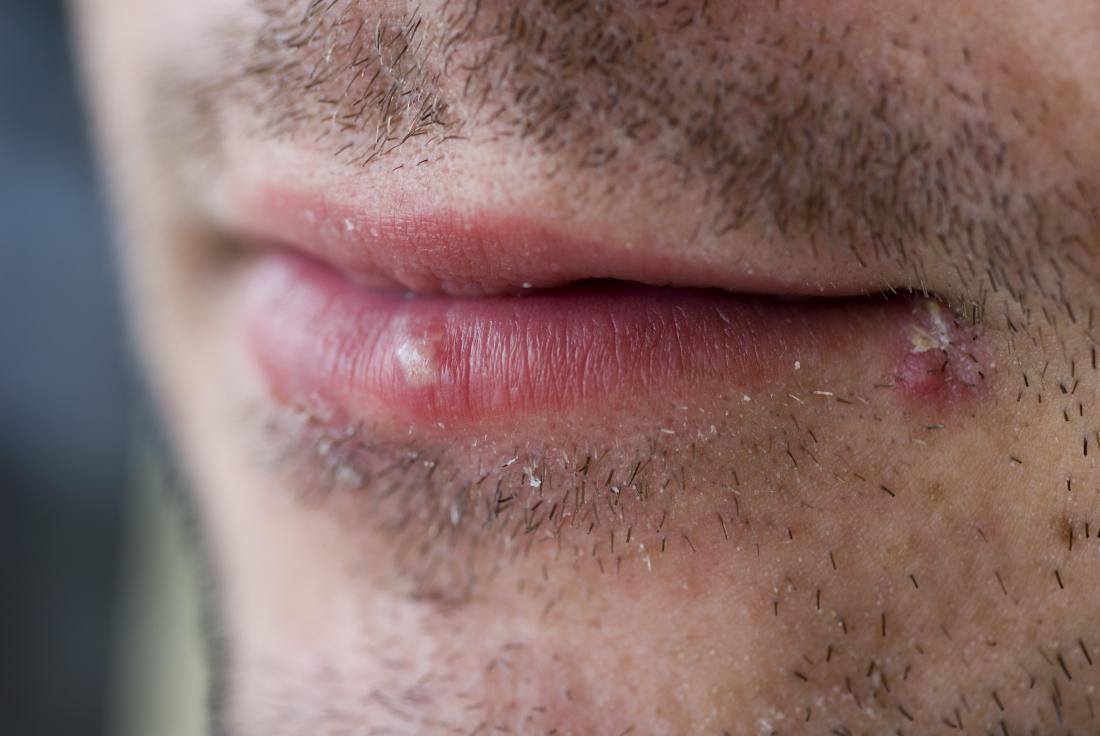 Cold Sore Vs Pimple Differences Similarities And Treatment