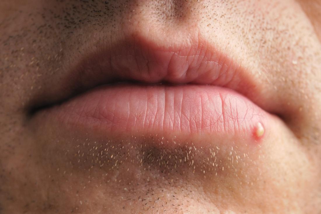 Cold sore vs. pimple Differences, similarities, and treatment