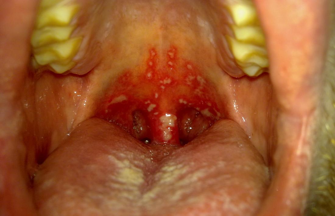 herpetic stomatitis Image credit: Klaus D. Peter, Gummersbach, Germany, 2011