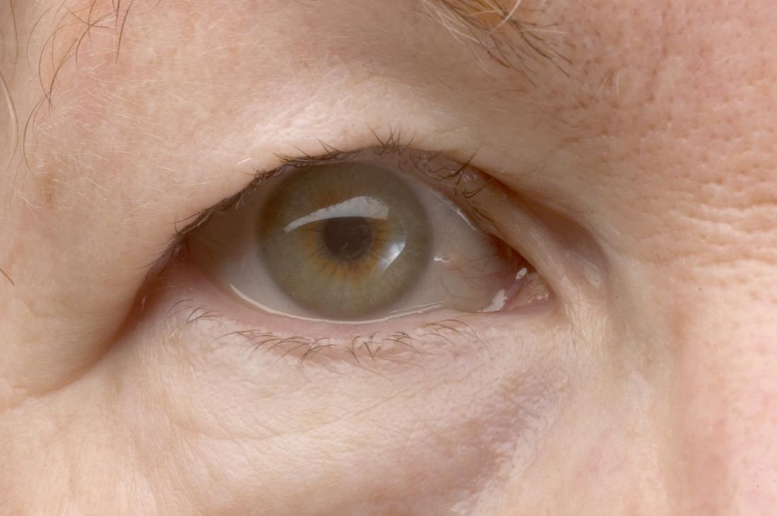 Droopy eyelid ptosis Causes risk factors and treatment