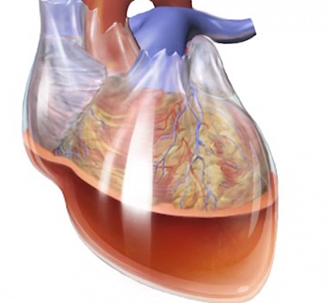 A buildup of fluid around the heart muscles causes cardiac tamponade. Image credit: Blausen.com staff, 2014.