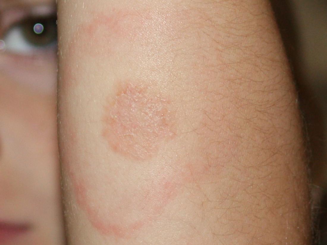 Lyme disease rash Symptoms, stages, and identification