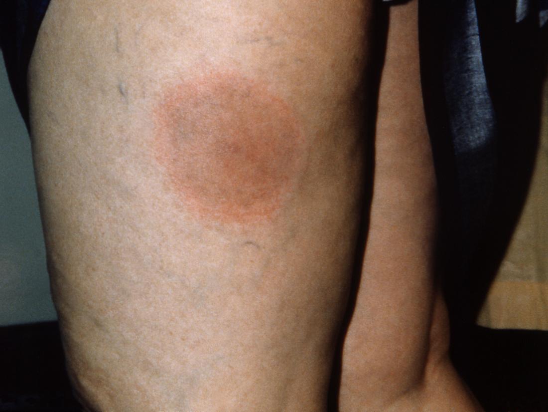 Lyme Disease Rash Symptoms Stages And Identification