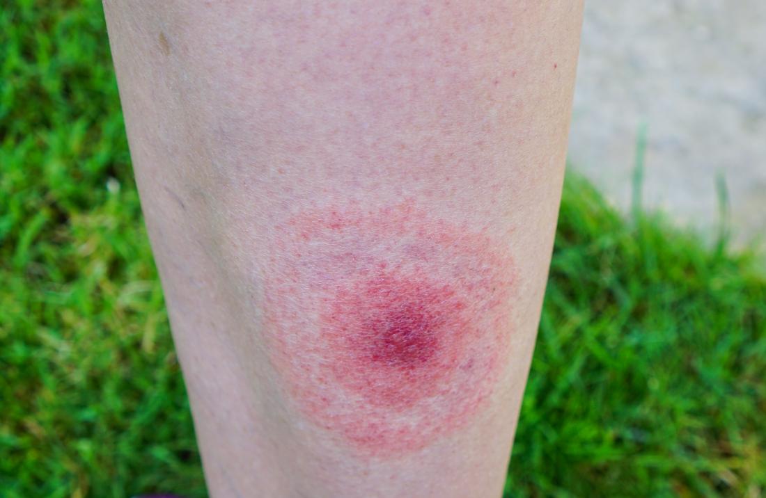 Lyme disease rash: Symptoms, stages, and identification