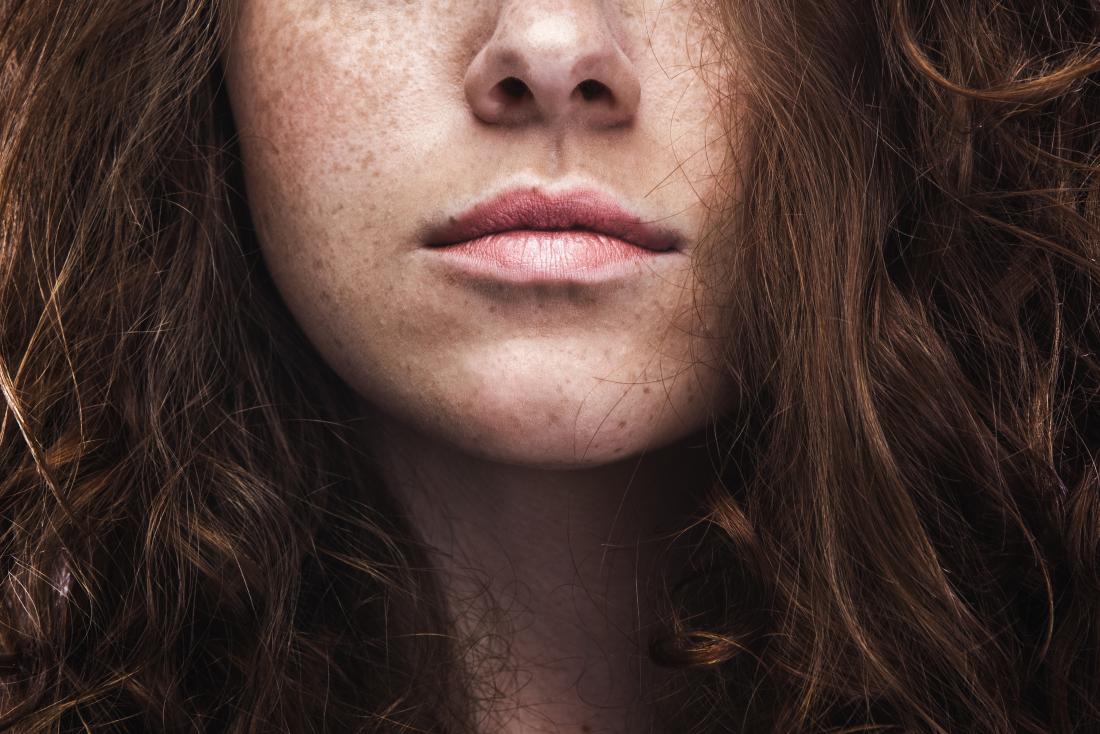 Naturally freckles to how remove and moles Freckles and