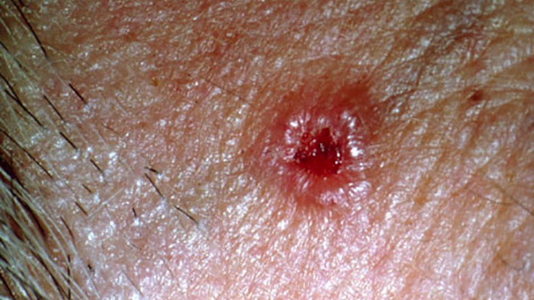 Cancer Bumps On Skin