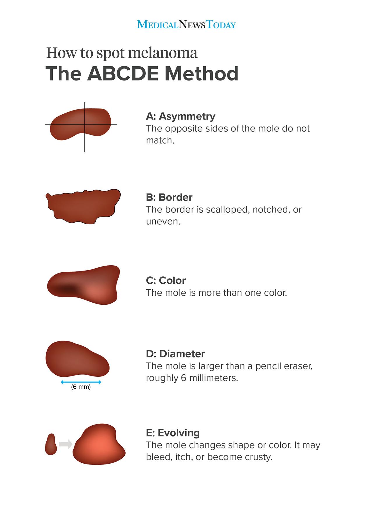 Skin Cancer Moles Early Stages