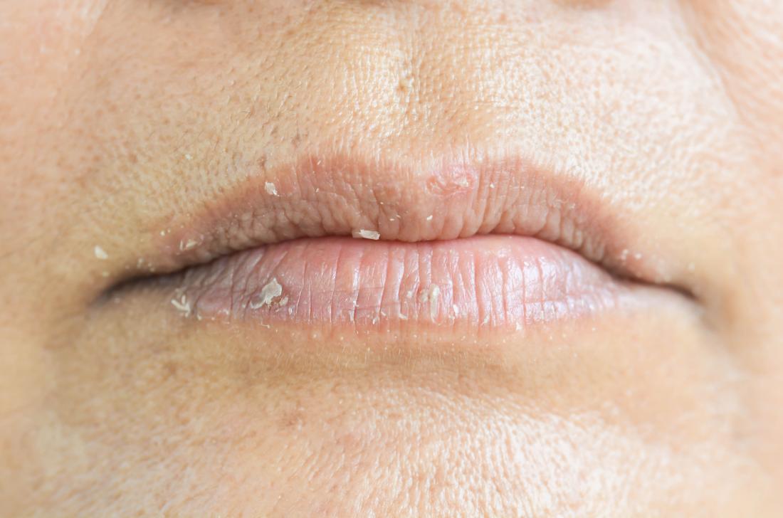 Eczema On The Lips Types Triggers Causes And Treatment