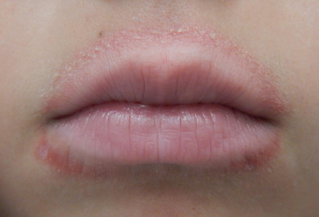 yeast on lips