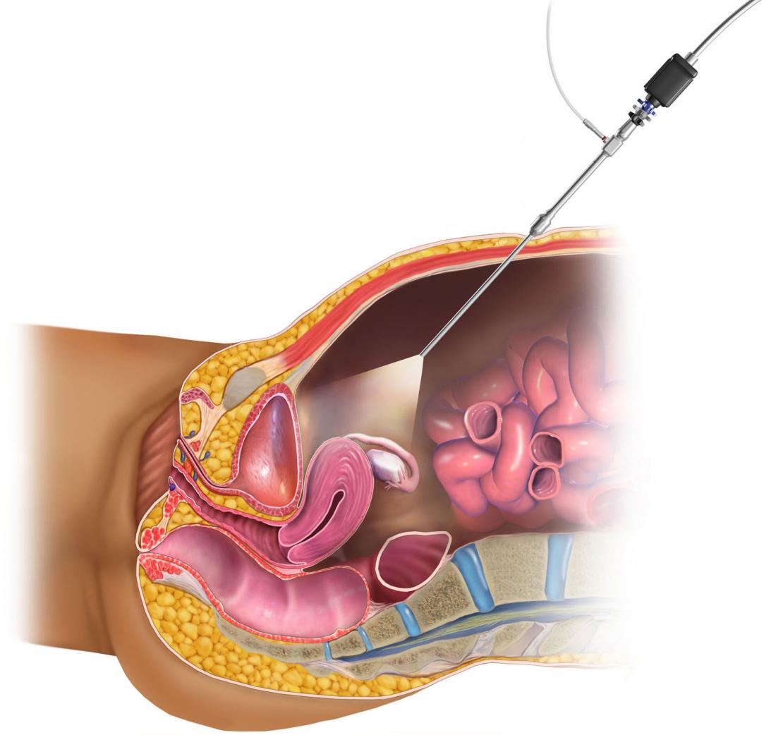 Laparoscopy <br>Image credit: Blausen.com staff, Medical gallery of Blausen Medical, 2014</br>