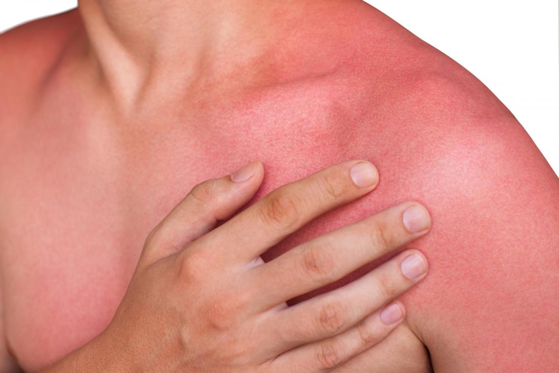 redness sunburn causes