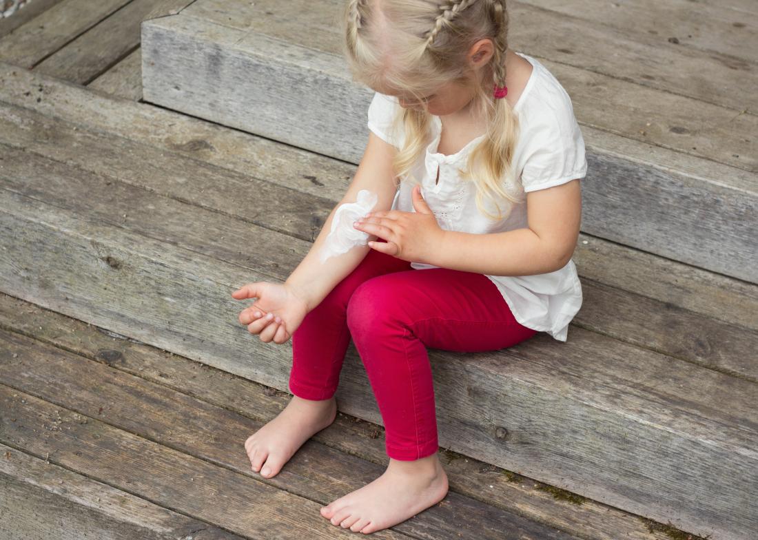 severe eczema treatments for children