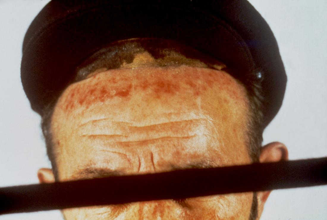 Sores And Scabs On Scalp Pictures Causes And Treatment