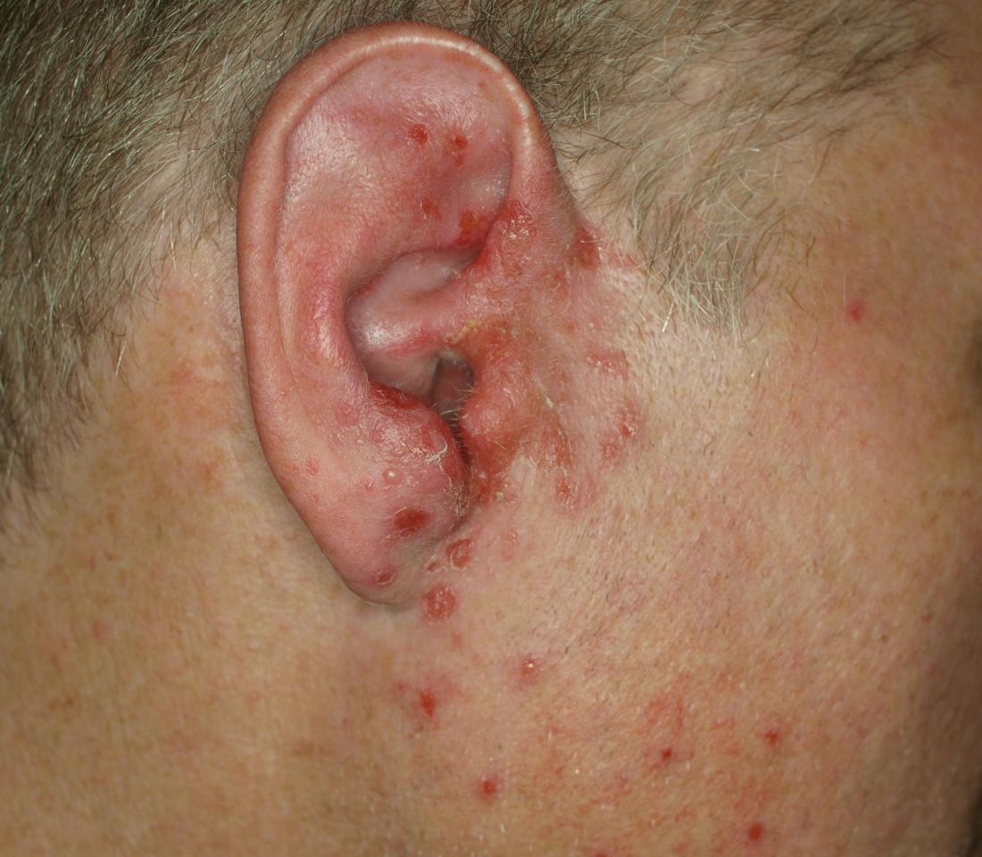 Impetigo on a mans ear <br>Image credit: Klaus D. Peter, 2017</br>