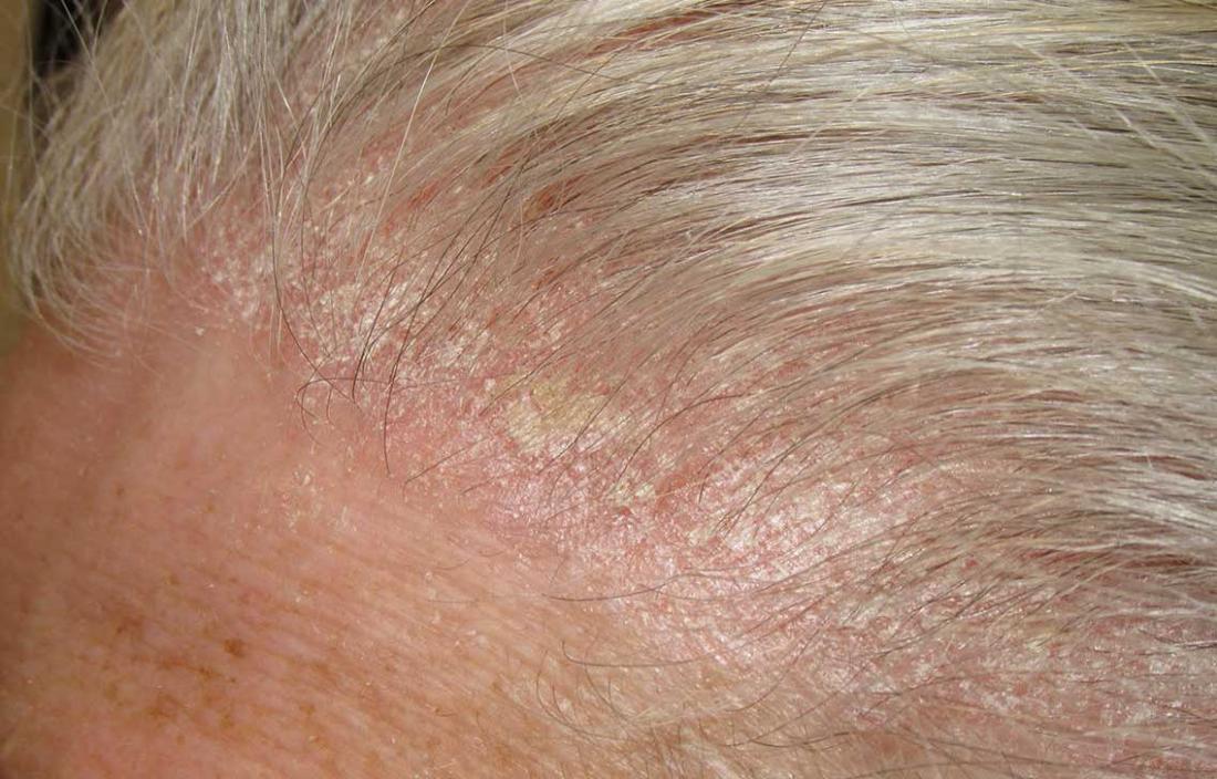 Red Patches On Scalp And Thinning Hair | Red Hair