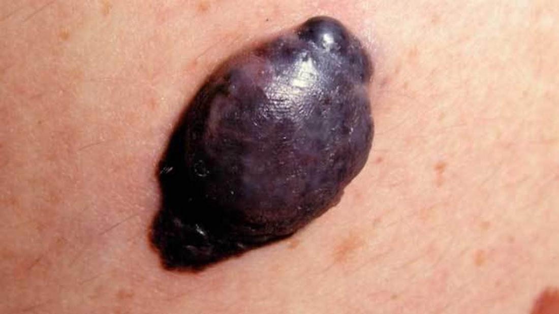 What does a melanoma look like