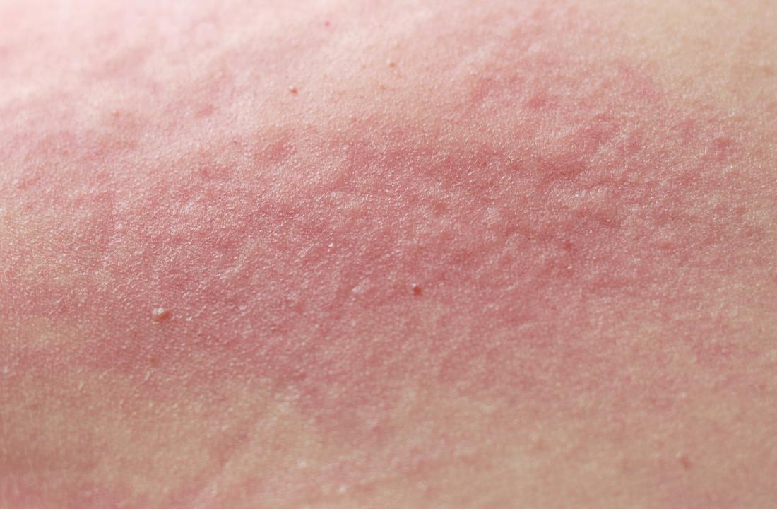 https://cdn-prod.medicalnewstoday.com/content/images/articles/323/323632/redness-rash-on-skin.jpg