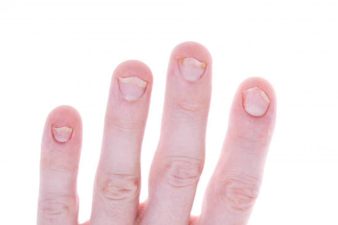 Nail psoriasis