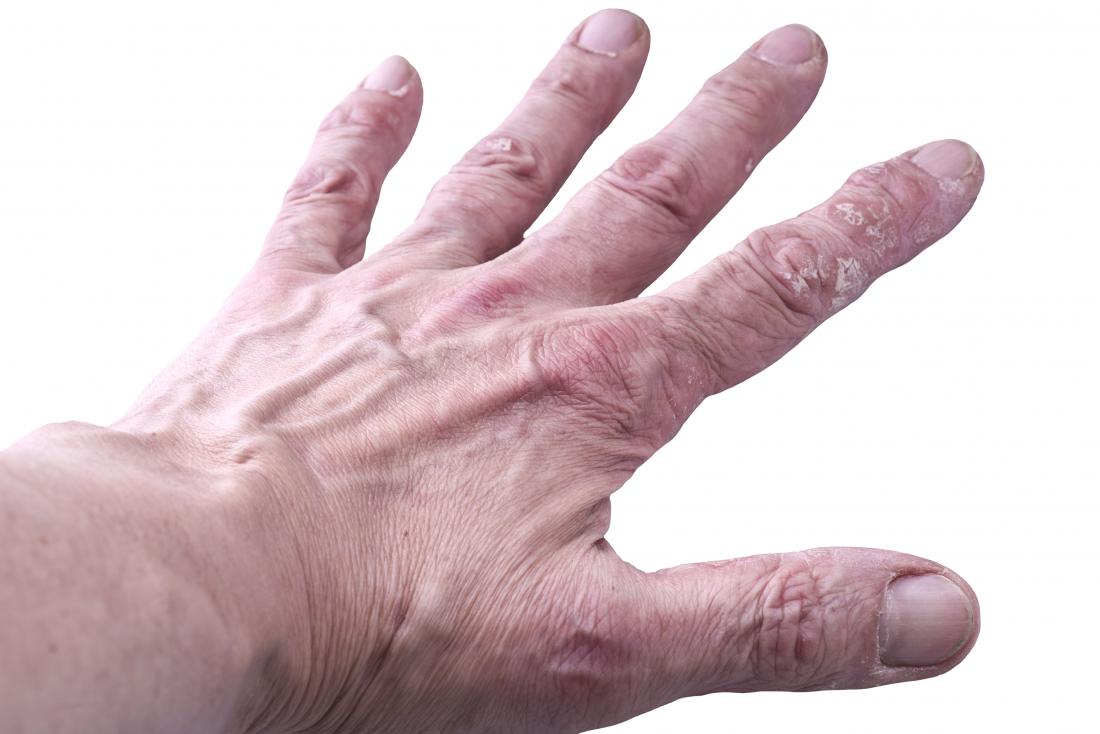 Psoriatic arthritis