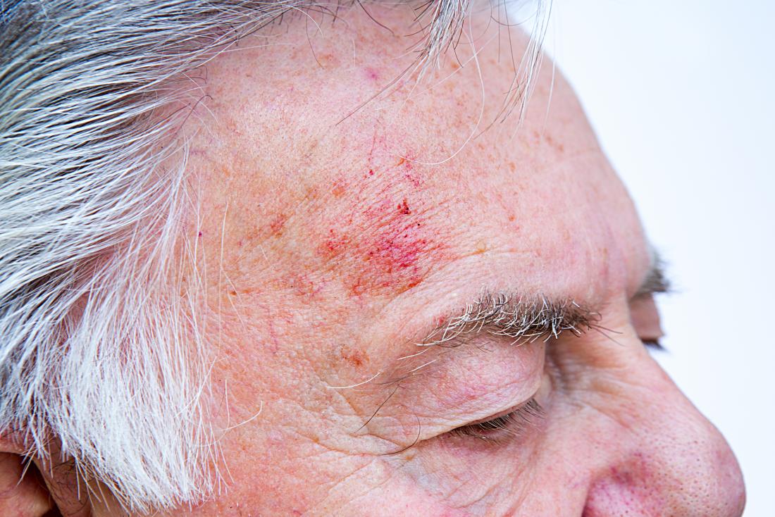 Senior man with a head injury