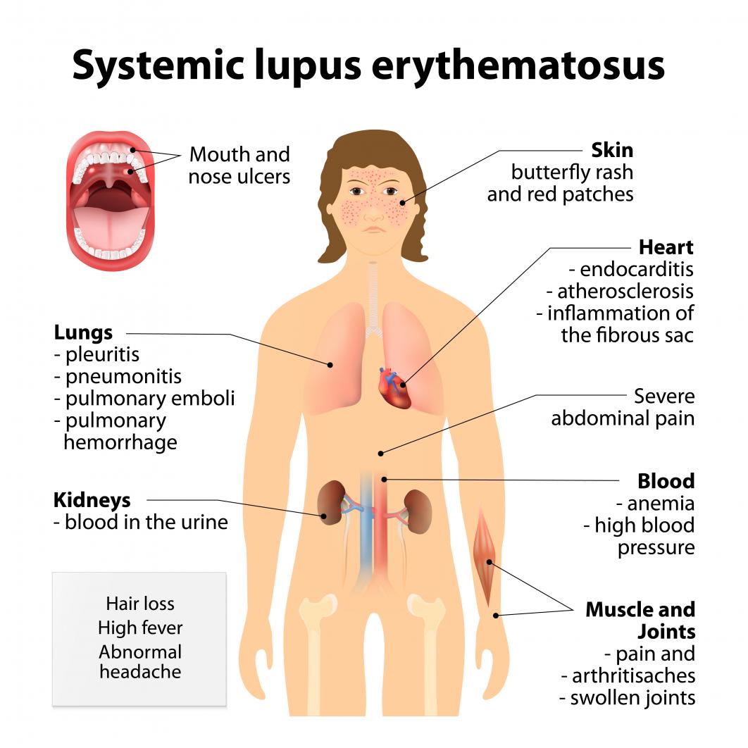 Systemic lupus erythematosus: Symptoms and treatments