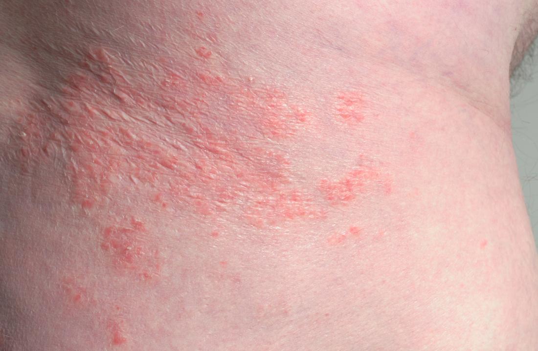 MyMed.com on X: Intertrigo-inflammatory skin rash that occurs due to  chafing. Occurs underneath breasts, armpits, groin, abdomen, inner thighs,  crease of neck, in between toes, fingers, between buttocks & genitals.  Symptoms: Itchy