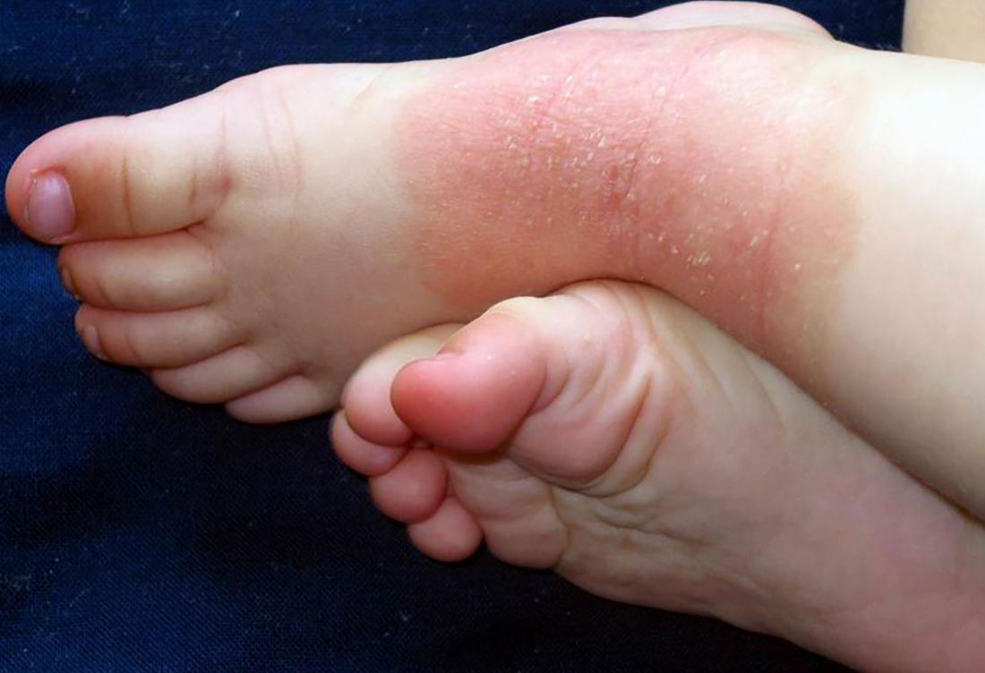 psoriasis on toes kezelés