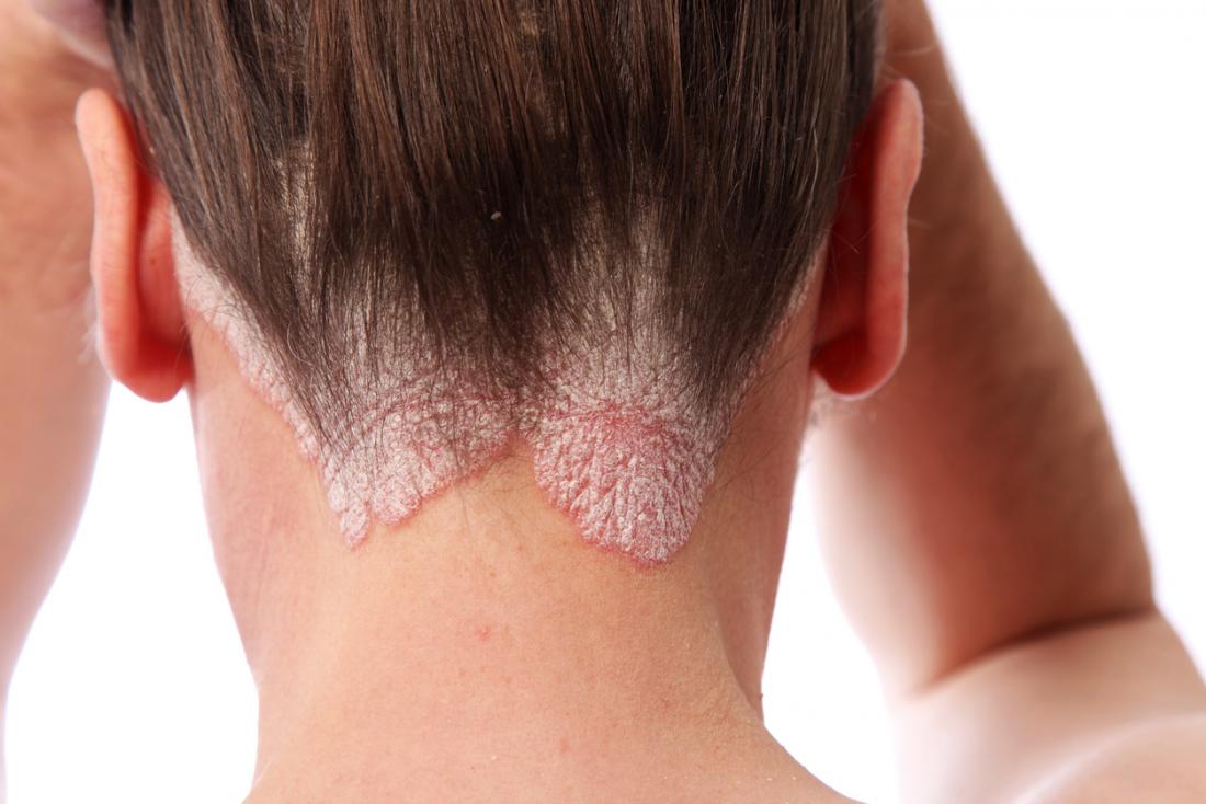 human head with psoriasis
