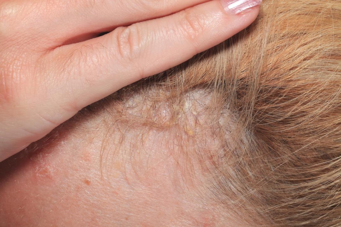 scalp psoriasis close-up under the hairline