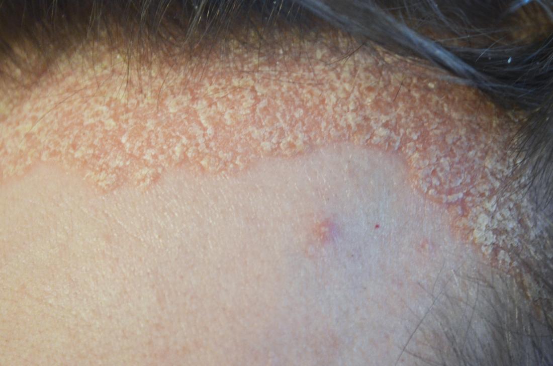 Scalp Psoriasis Pictures Symptoms And Treatment