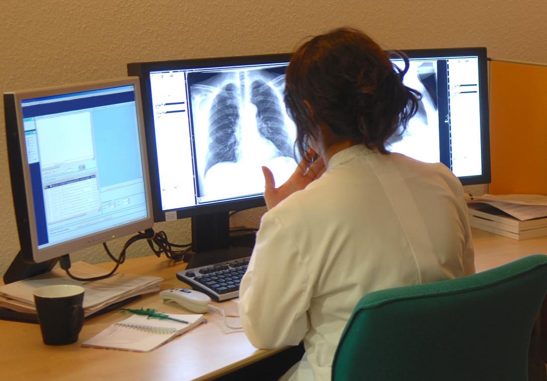 lung cancer scans