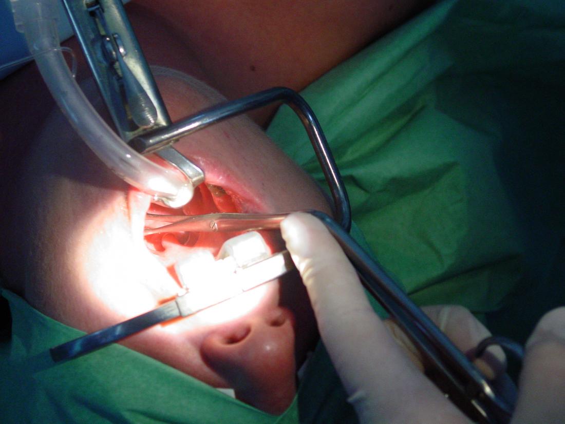 tonsillectomy procedure br image credit welleschik 2001 br