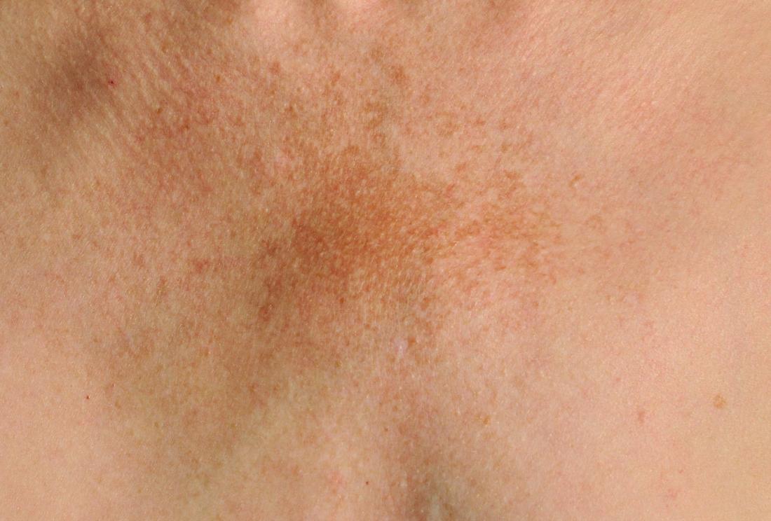 Melasma on woman's chest