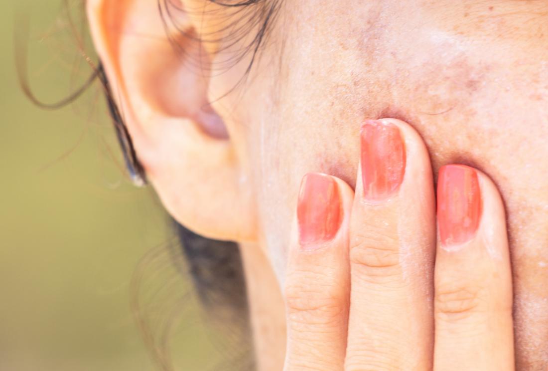 Woman applying ointment or cream to hyper-pigmented face close up