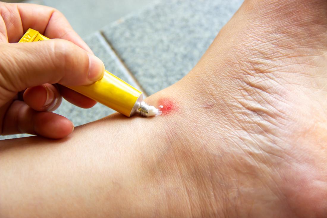 https://cdn-prod.medicalnewstoday.com/content/images/articles/323/323727/person-putting-antihistamine-cream-on-a-bite-on-ankle.jpg