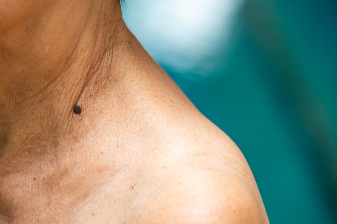 dark mole that potentially looks like melanoma on woman's neck