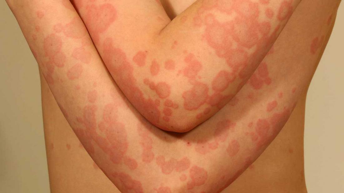 Erythema multiforme: Symptoms, pictures, causes, treatment
