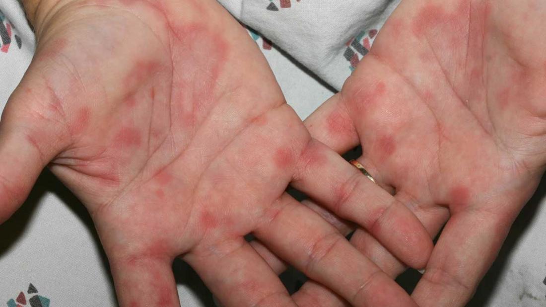 What does a rash on the palm of your hand mean