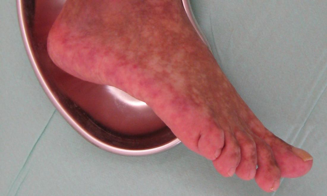 Forstyrrelse Misforstå loyalitet Purple feet: Causes and treatment