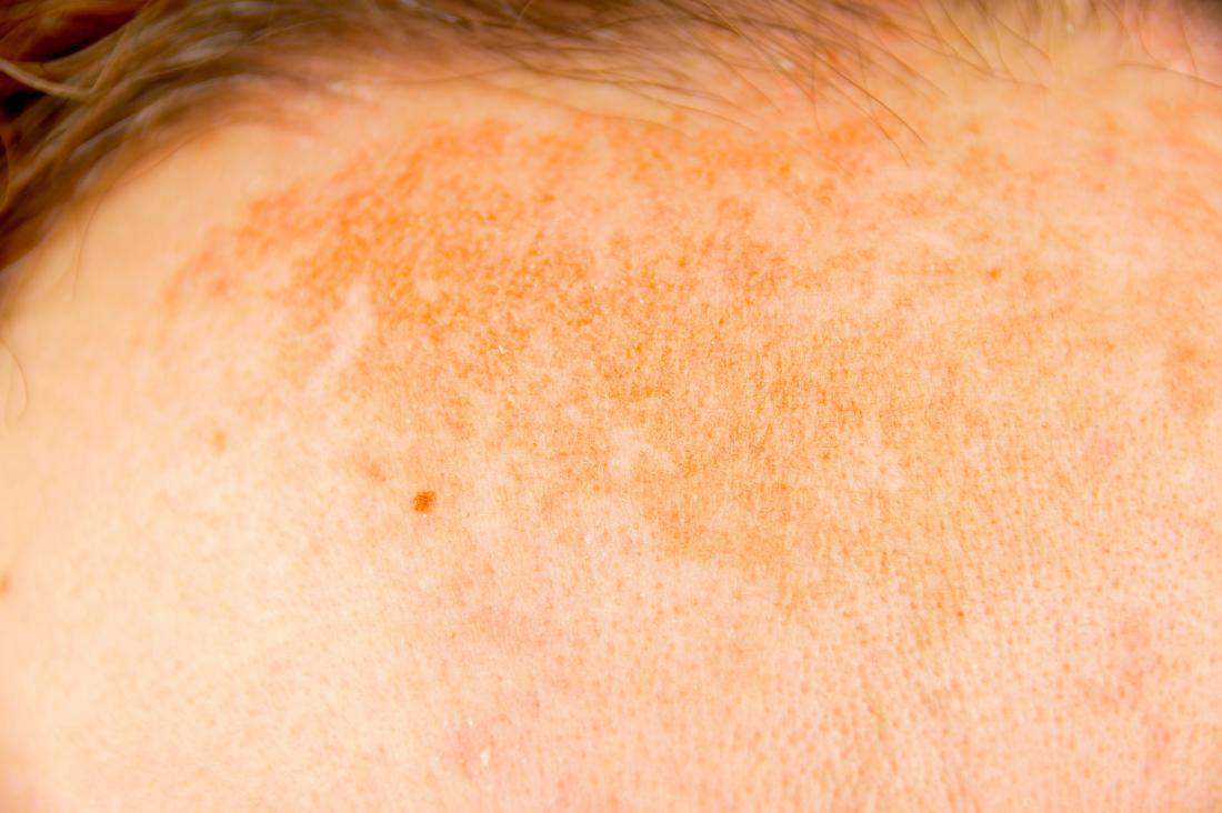 Hyperpigmentation: Treatment, types, and causes - Richmond Hill