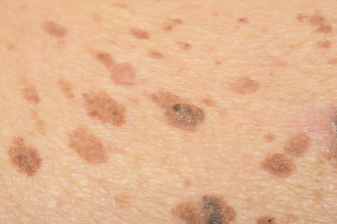 Melasma freckles on skin.