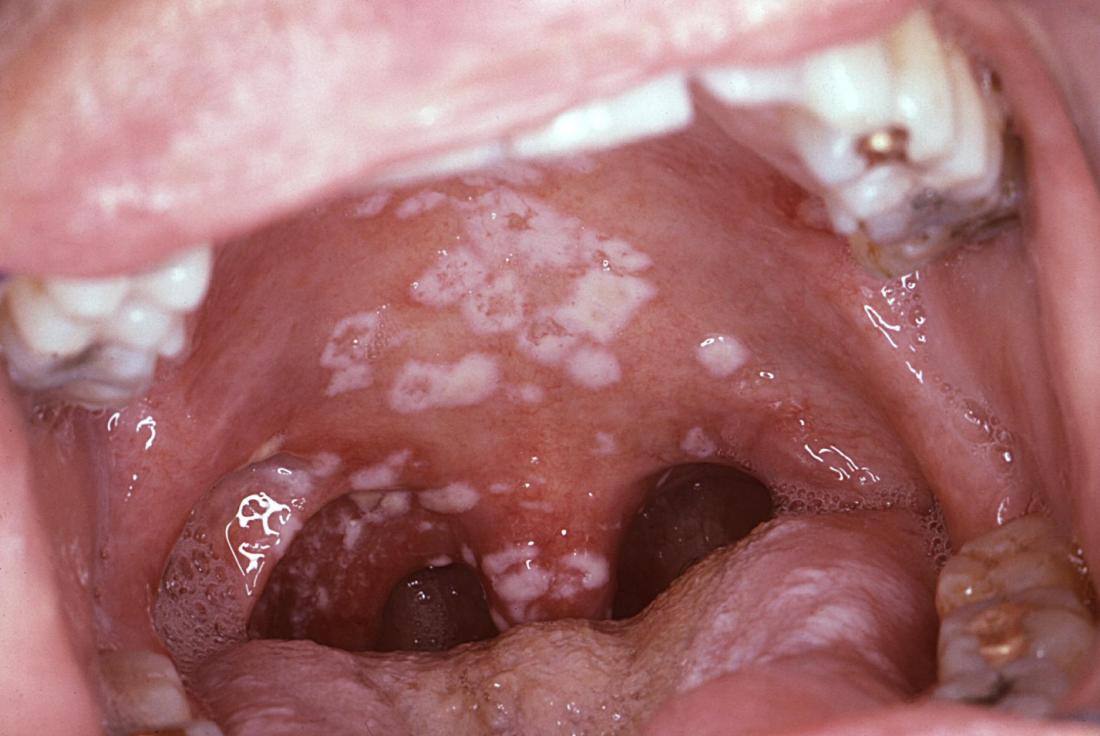 hiv bumps under tongue