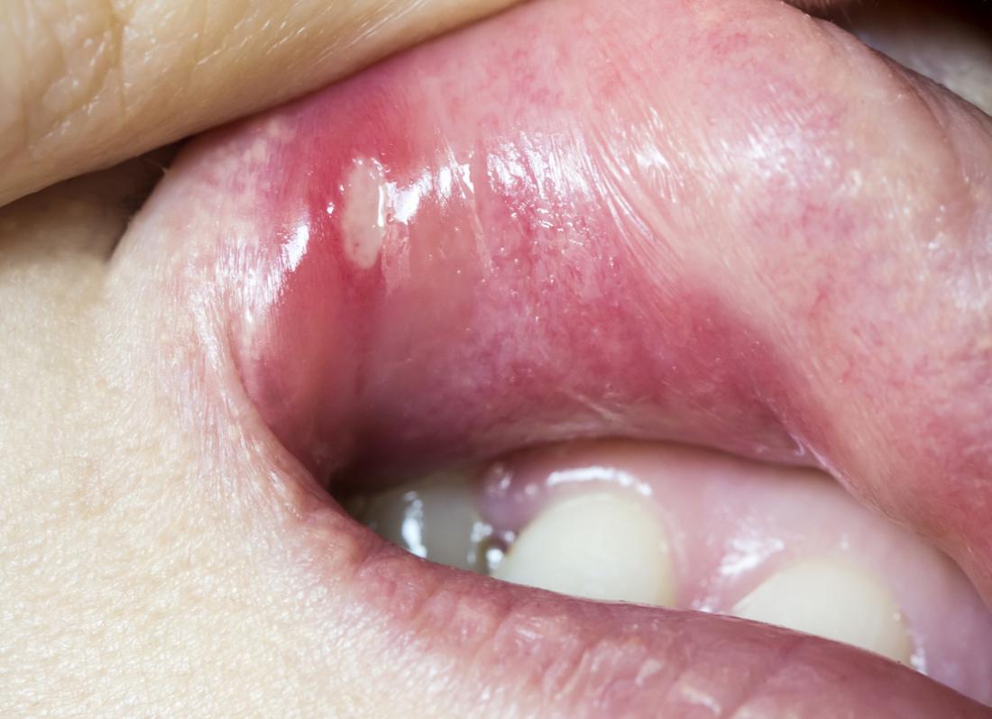 Hiv Mouth Sores Pictures Causes Treatment And Prevention