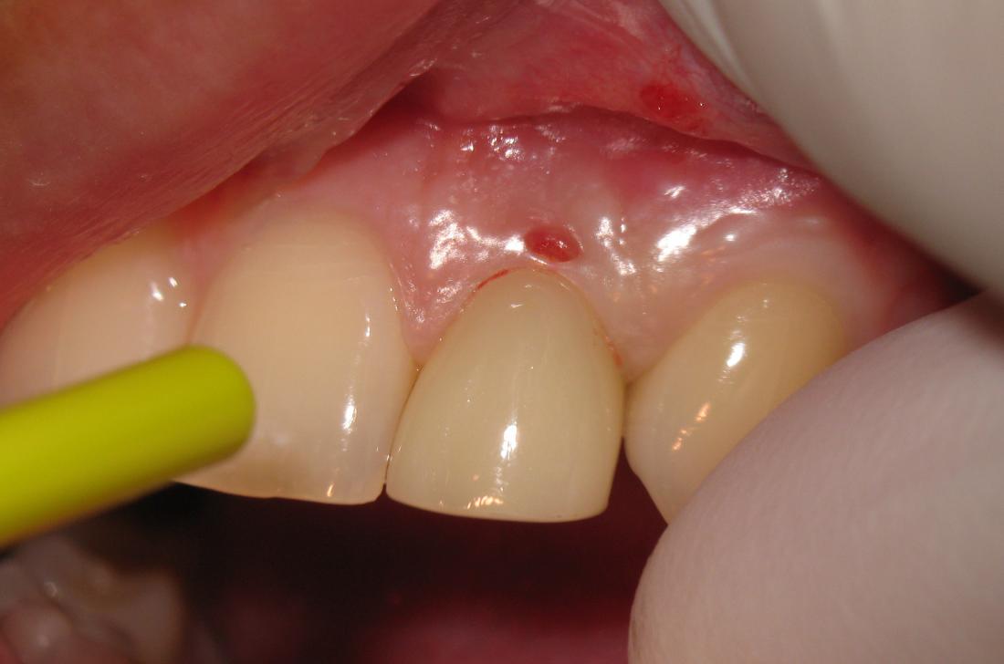 Monument Ln Let K T M Mrtv Red Spot On Gums Ampa Sk Ko Sk S La   Hole In Gum Because Of Gum Disease Image Credit Dr Dentist Dds 2013 