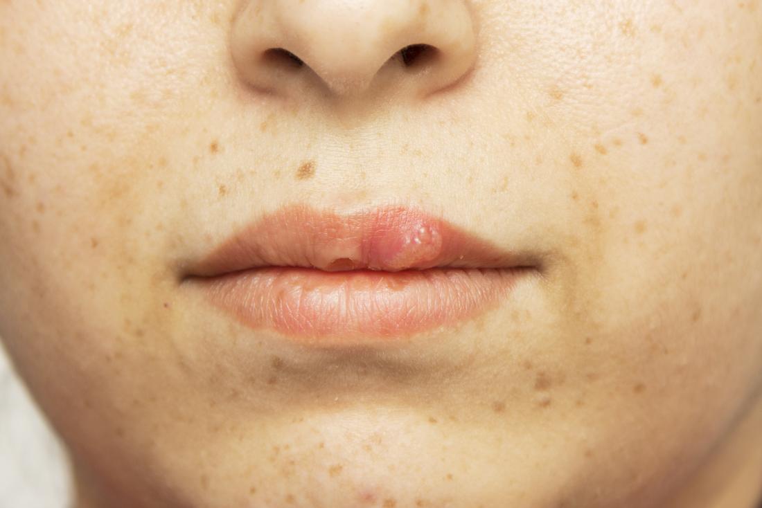 beginning-stages-of-herpes-in-the-mouth-livestrong