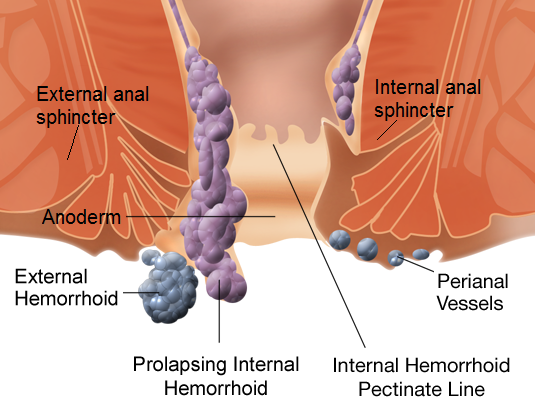 Hemorroides: Síntomas, tratamientos