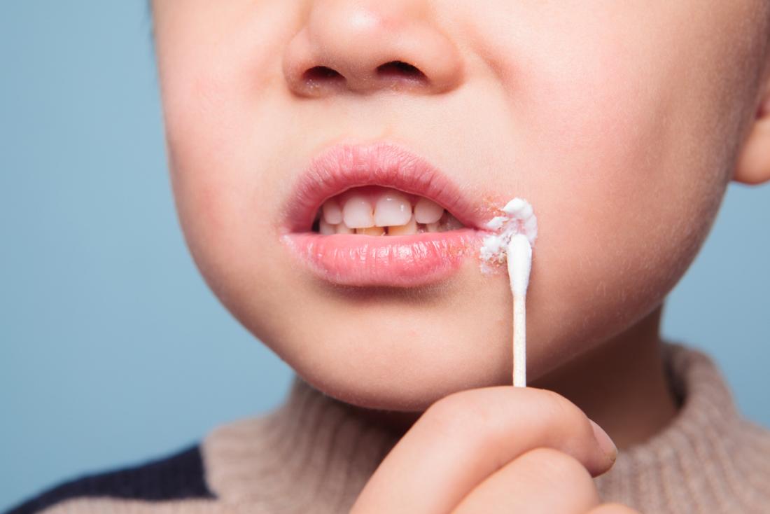 ¿Por qué sale el herpes labial y cómo se puede curar?