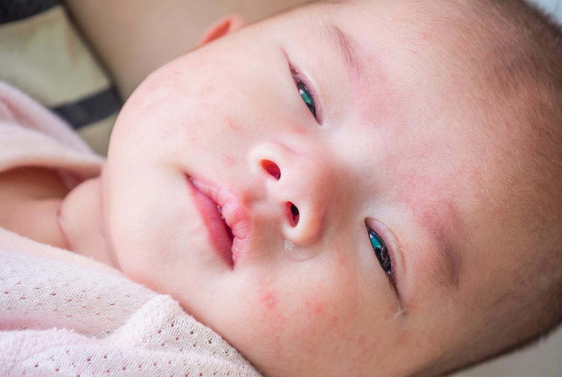 Baby red spots on face and neck